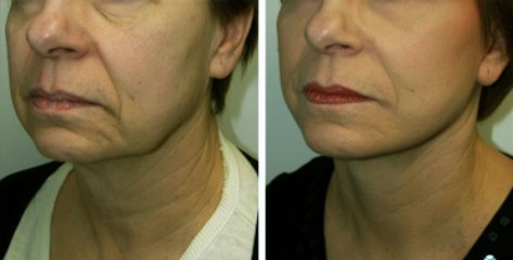 Yüz Gerdirme Operasyonu Hakkında Bilinmeyenler