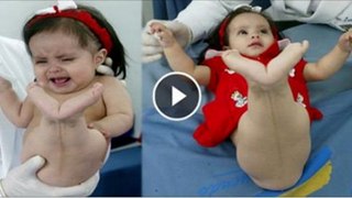 A Baby Born With Fish Shaped Body