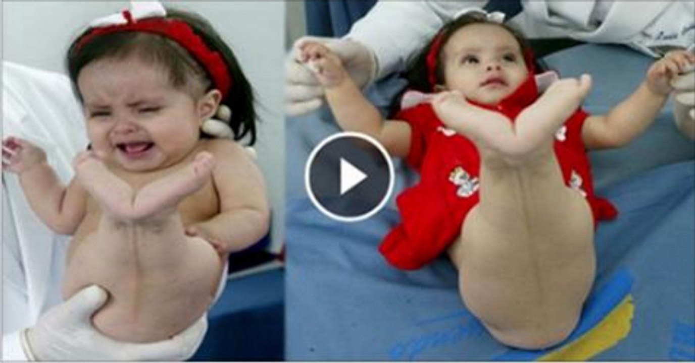 A Baby Born With Fish Shaped Body