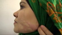 Reyhanlı 52 Kişi Ölürken Yüzünden Yaralanan Suriyeli Zehra Estetik Ameliyat Olmak İstiyor