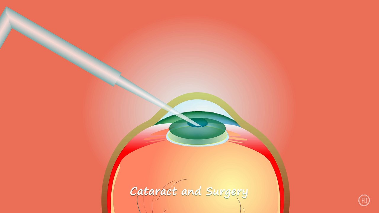 Cataract and Surgery | Medical Education | HD Video | F1 Digitals