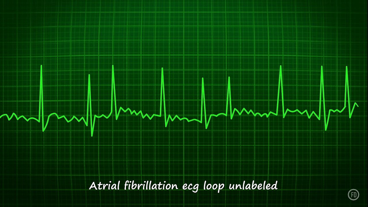 Atrial fibrillation ecg loop unlabeled | Medical Education | HD Video | F1 Digitals