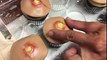 Cupcakes en forme de boutons d'acné
