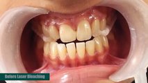 Teeth Whitening In Bangalore - Best Dental Clinic In Indiranagar