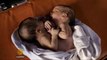 Syrian conjoined twins die awaiting surgery