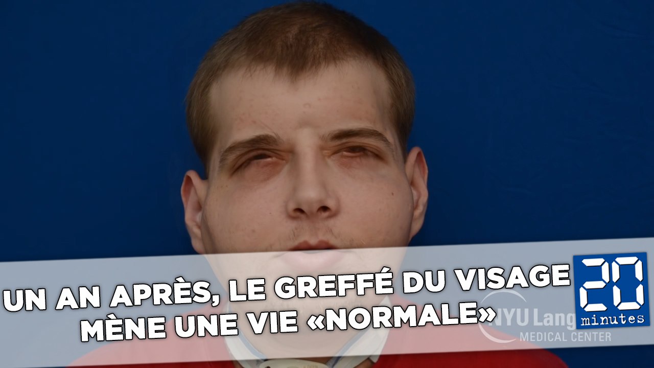 Un an après, le greffé du visage mène une vie «normale»