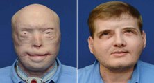 L'incroyable métamorphose du visage de Patrick Hardison, le pompier brûlé au 3ème degré après sa greffe du visage