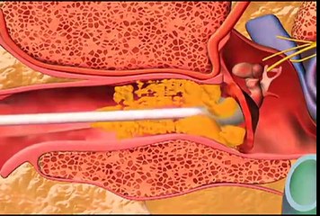 Ear WAx machine As Seen on TV 0334-1113342