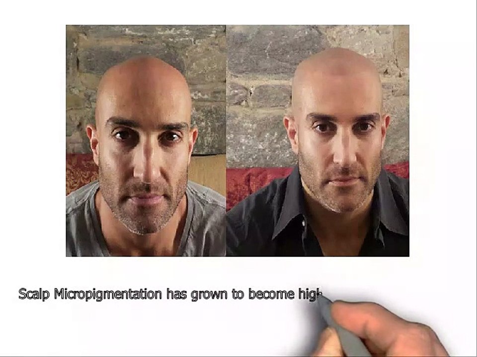 Scalp micropigmentation