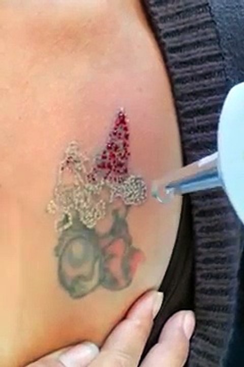 How does tattoo removal laser work-Unwanted Tattoos