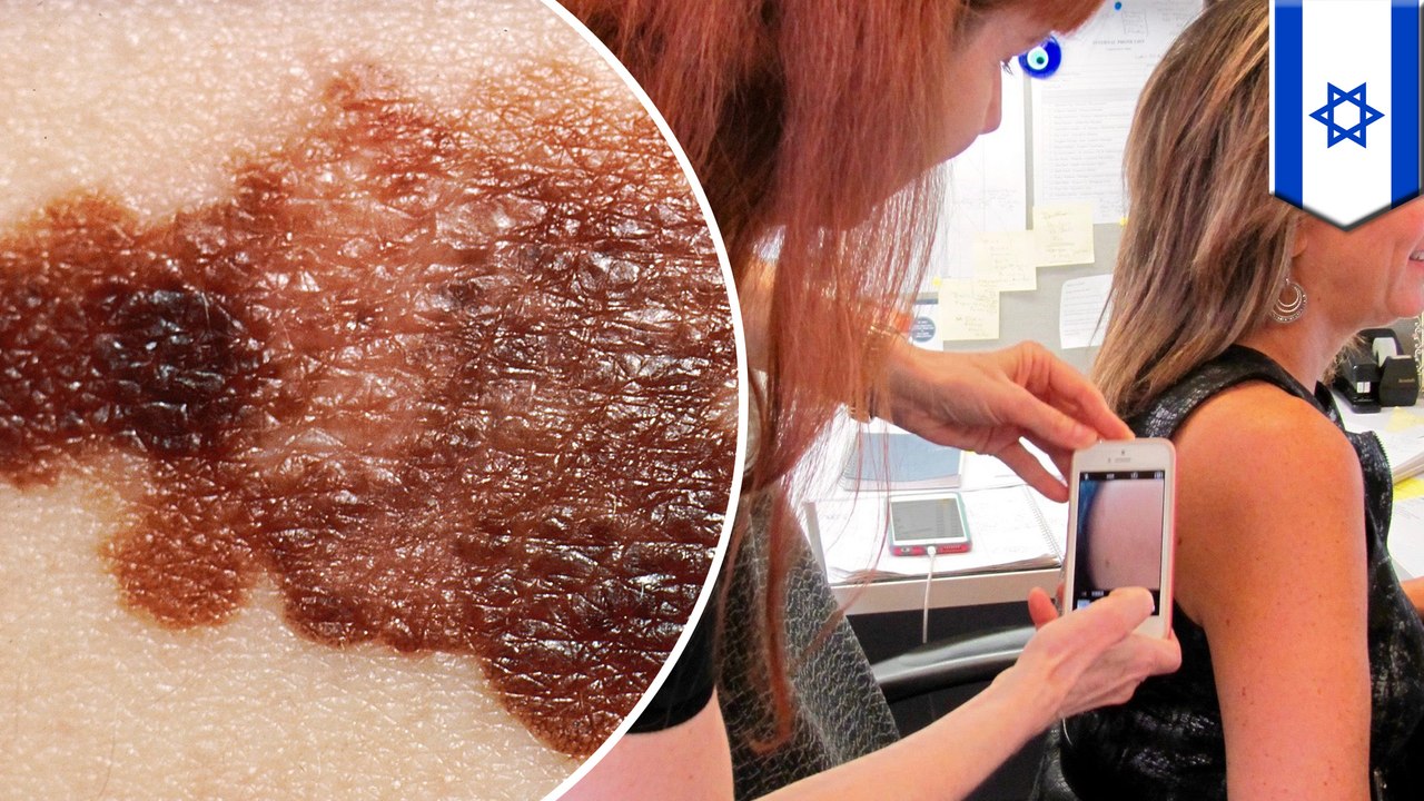 悪性黒色腫（メラノーマ）、全身に広がるメカニズムとは？