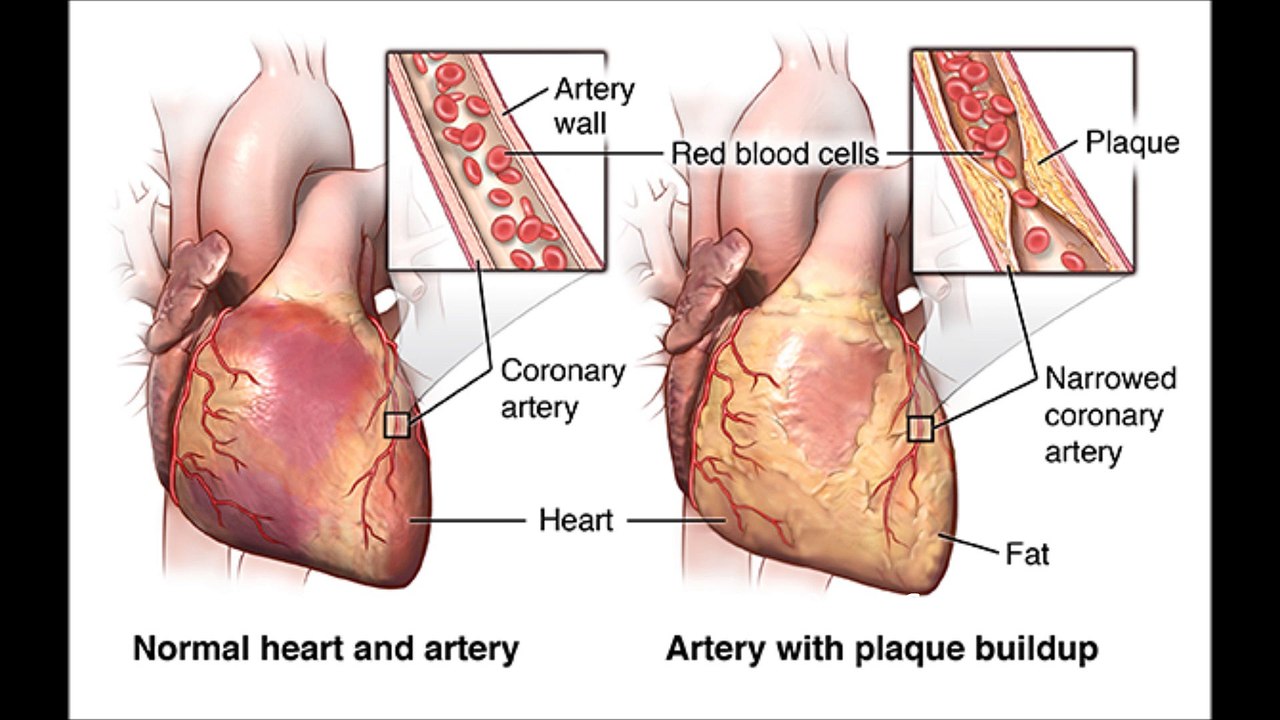 Dr Manish Bansal MD Jacksonville Fl talks on Congestive Heart failure &  Acute Myocardial Infarction