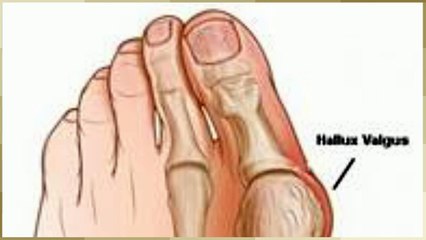 Bunions Treatment and Care