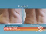 Coolsculpting at Vein Med Solutions