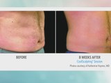 Precise Body Contouring holds event to learn about Coolsculpting