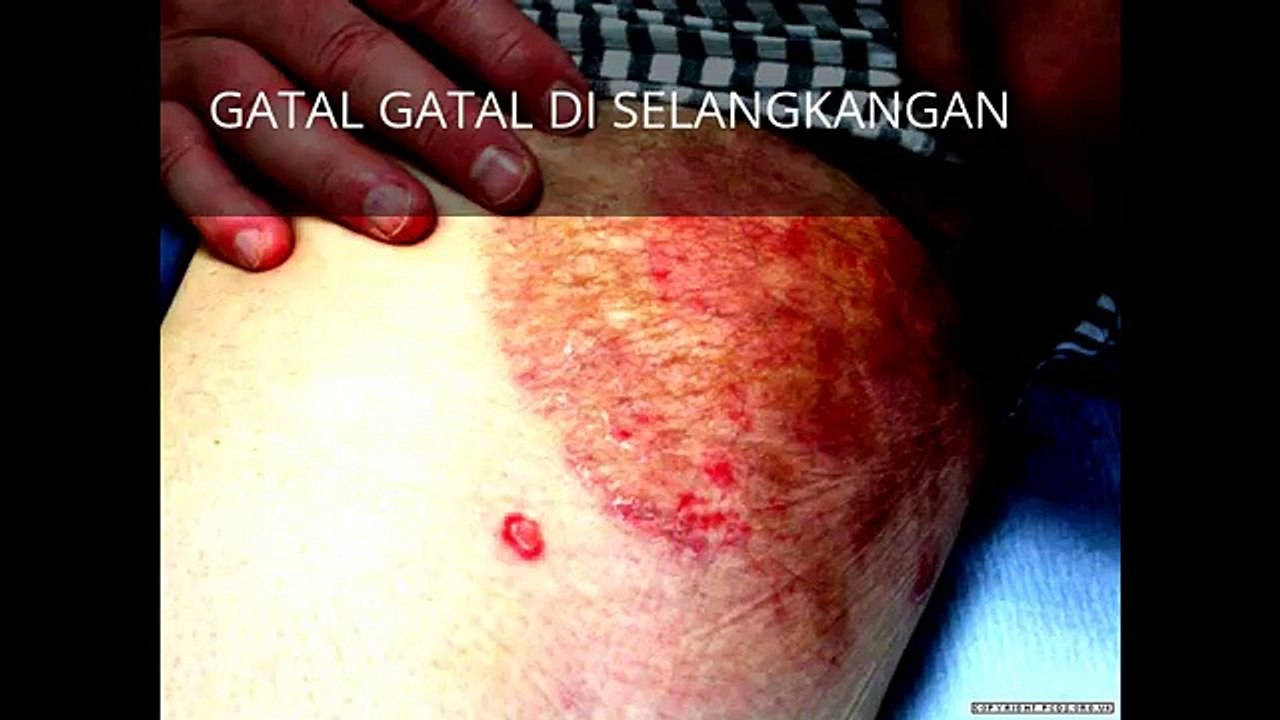 JUAL OBAT GATAL HERBAL  087736929384