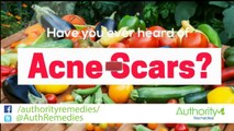 Home Remedies - Acne Scar Treatment