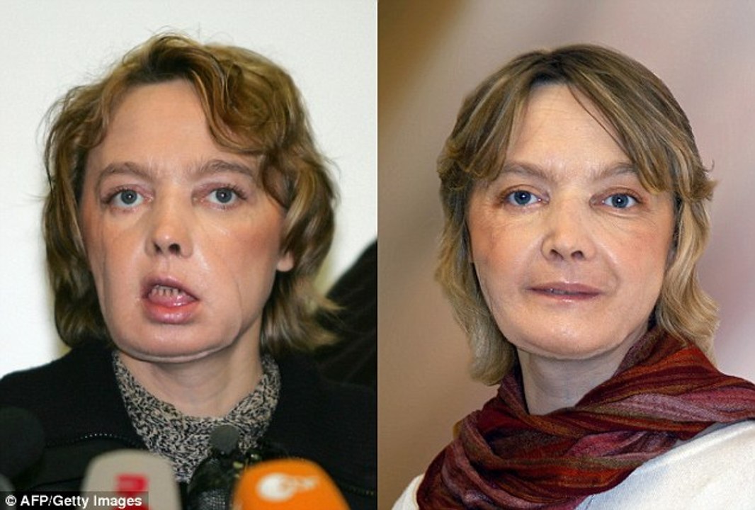 10 Most Shocking Face Transplants Ever