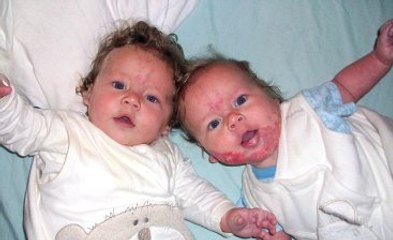 Doğum Lekesi Nefes Borusuna Kadar Yayılınca Boğulma Tehlikesi Geçirdi