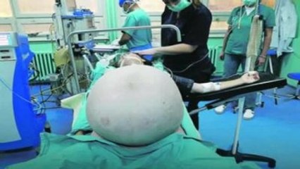 52 Yaşındaki Kadının Karnından 30 Kiloluk Tümör Çıktı