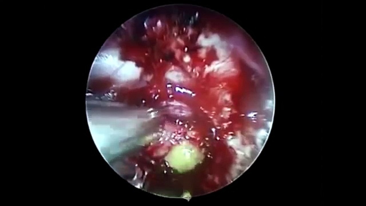 Endoscopic Skull Base Surgery for Intrasellar Craniopharyngioma