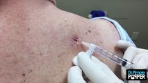 Back Blackhead Extraction Session #2 in 