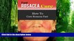 Big Deals  Fast Rosacea Cure - How To Cure Rosacea Fast (Rosacea Treatments, Rosacea Diet
