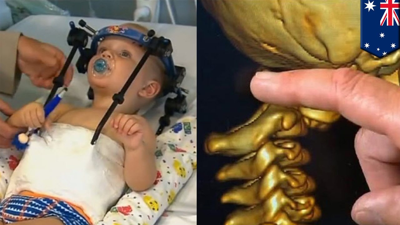 มหัศจรรย์ ต่อศรีษะเด็กหัดเดิน วิวัฒนาการทางการแพทย์เยี่ยม