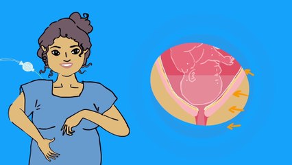 Le point sur l'anesthésie péridurale