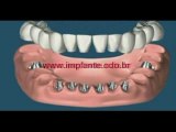 implants et prothèse dentaire