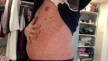Fat freeze system client review - Coolsculpting at home  wwwfatfreezesystem.com Review