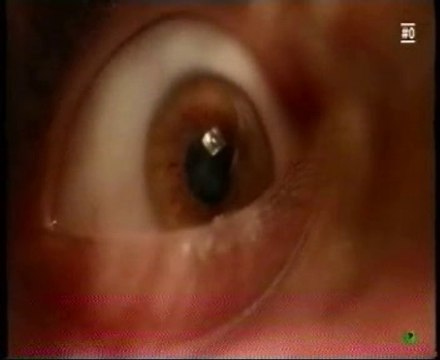 Cerebro vegetativo: Respuestas minimas de consciencia (Test auditivo)