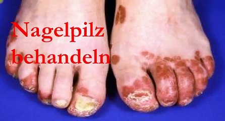 Nagelpilz behandeln mit Zetaclear