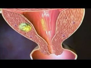 CANCER DE L'uterus