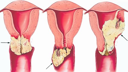 Why Might Vegetarians Have Less HPV?