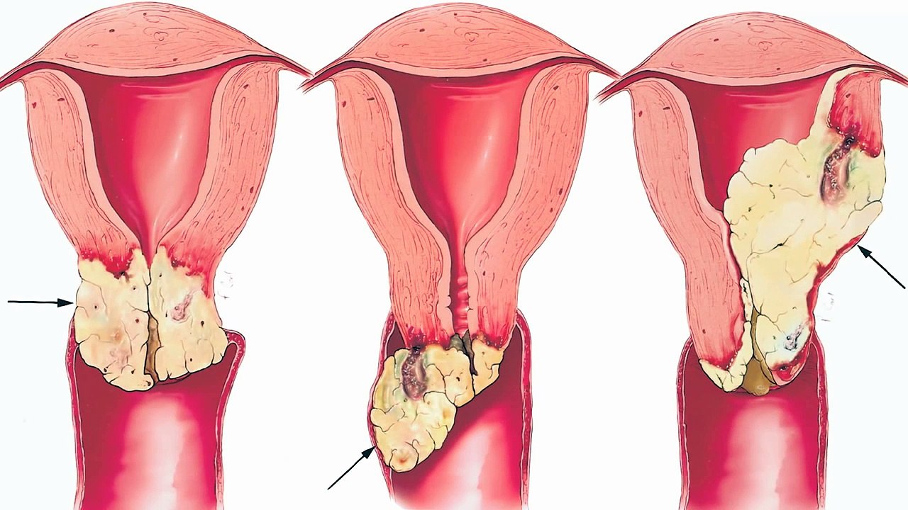 Why Might Vegetarians Have Less HPV?