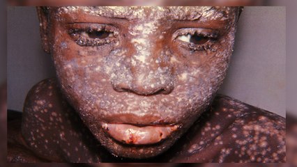 Top 10 Deadliest Diseases In the World