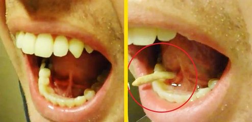 Ağzından tükürük bezi taşı çıktı #TükürükBezi