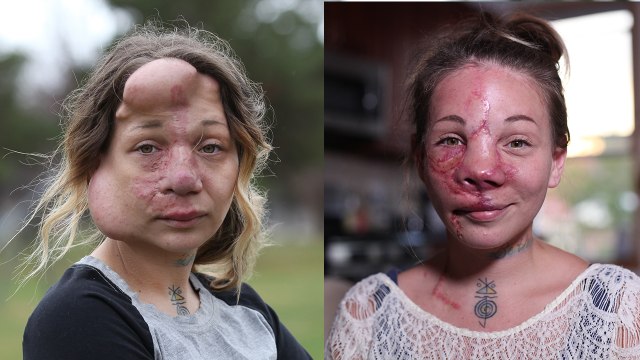 Mum Has Medical Balloons Removed From Her Face: BORN DIFFERENT