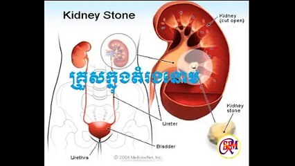 ក្រូសក្នុងតំរងនោម, Khmer Health, Health Cambodia, Kidney Stone