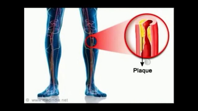 ជំងឺលើសឈាម, Khmer Health, Cambodia Health, Speak Khmer