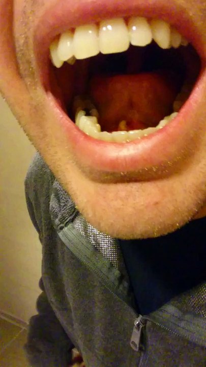 Il sort un calcul salivaire de sa bouche