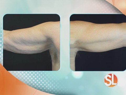 Fresh Start MedSpa first to offer Fusion Contouring