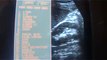 ultrasound study RENAL CALCULI vs RENAL CONCRETIONS - 1 of 2