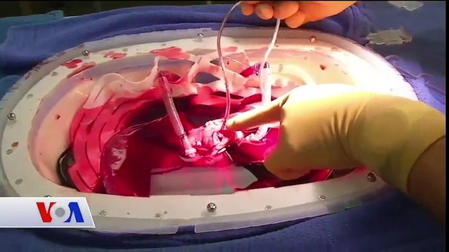 Karaciğer Naklinin Başarı Oranını Arttıran Araştırma