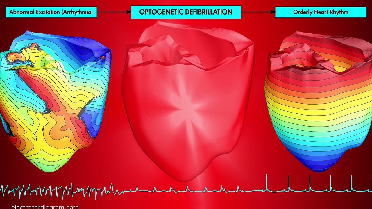 Defibrilación óptica