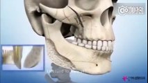 Video mô phỏng Quá trình phẫu thuật thẩm mỹ ở Hàn Quốc
