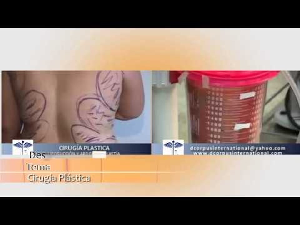 Salud, Belleza y Nutrición - Cirujía Plástica en Adolescentes - Alejandro Monsalve