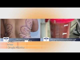 Salud, Belleza y Nutrición - Cirujía Plástica en Adolescentes - Alejandro Monsalve