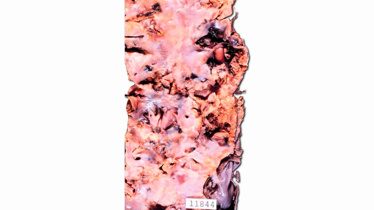 Abdominal aortic aneurysms: ticking time balloons